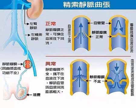 精索静脉曲张的症状有哪些